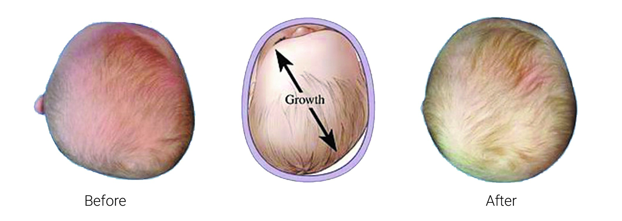 Plagiochephaly - InMotion Orthotics