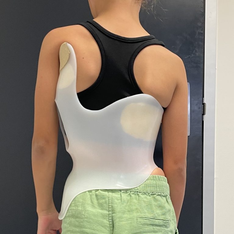 Scoliosis Bracing Inmotion Orthotics